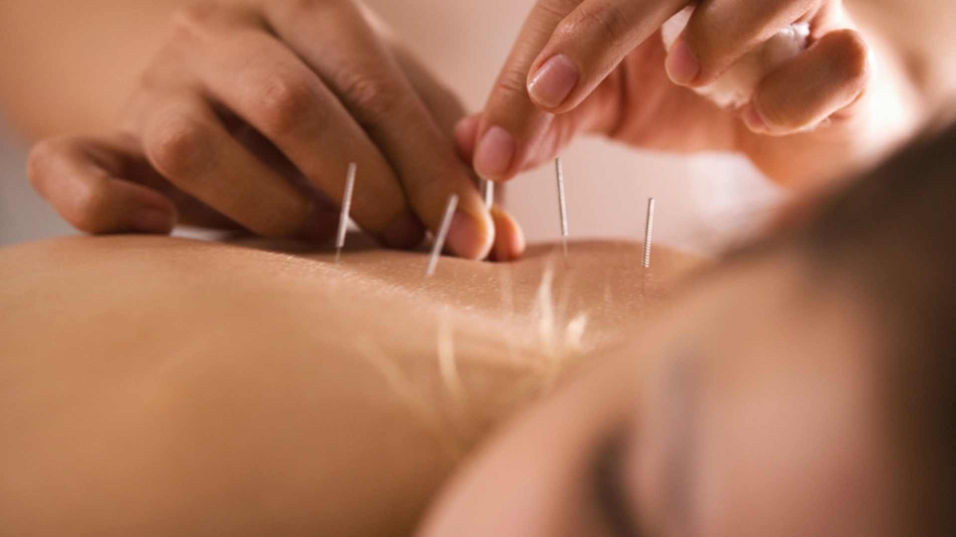 samsunakupunkturdoktoru